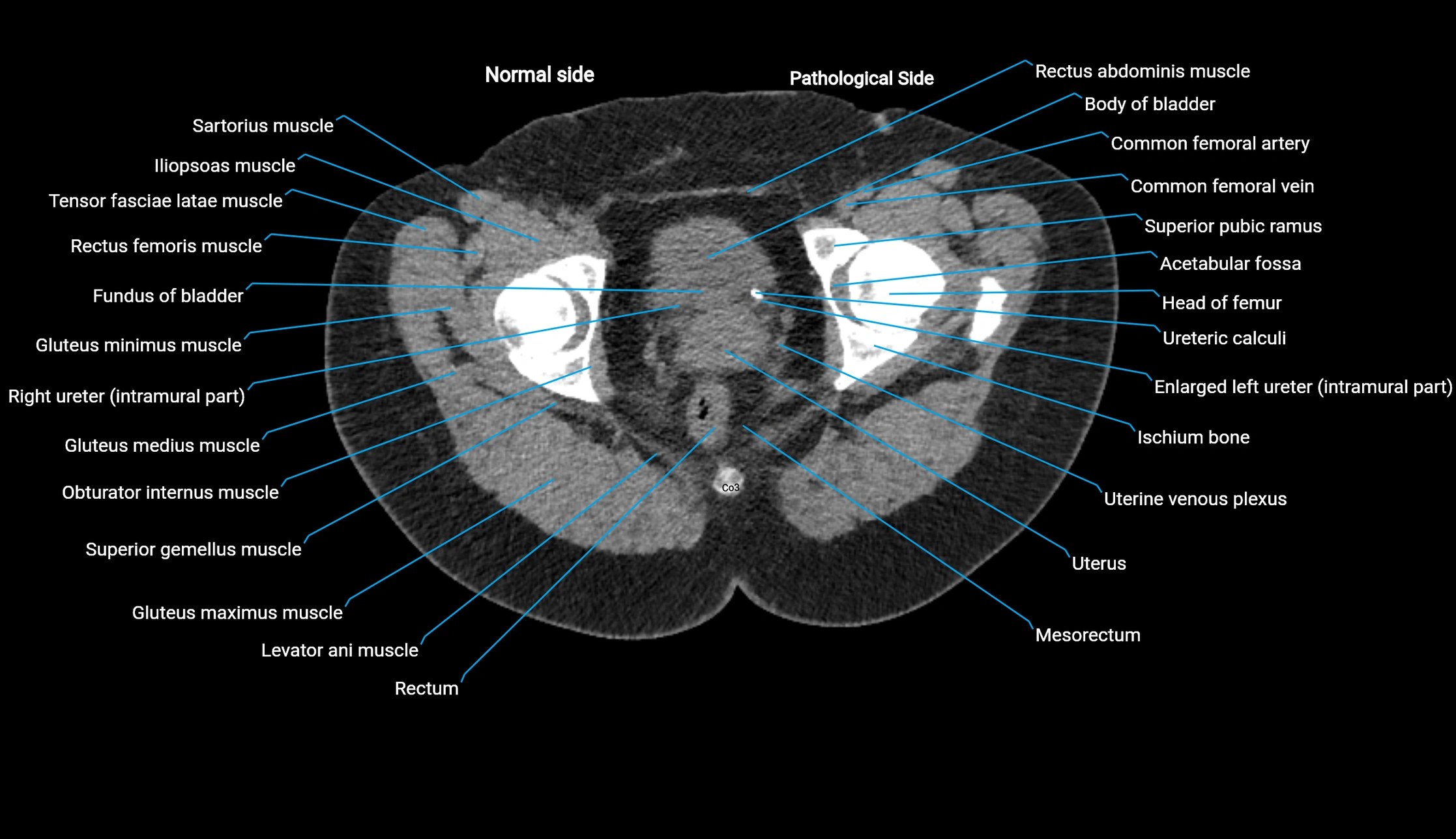 CT KUB axial cross sectional anatomy  radiology image -img-00201-00159.webp